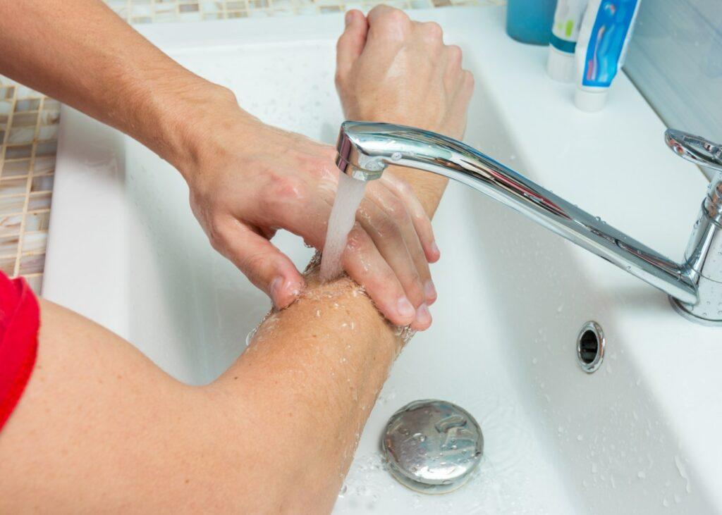 Quemado en el antebrazo curando con agua